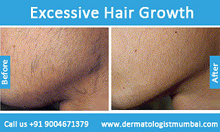 Get The best Hair Growth Treatment - Dermatologistmumbai.com.jpg
